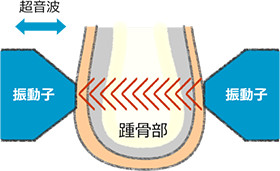 超音波骨密度測定装置 測定 イメージ